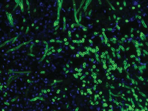 Fluorescence microscopy of human skin tissue section (paraffin fixation) with fungal infection.